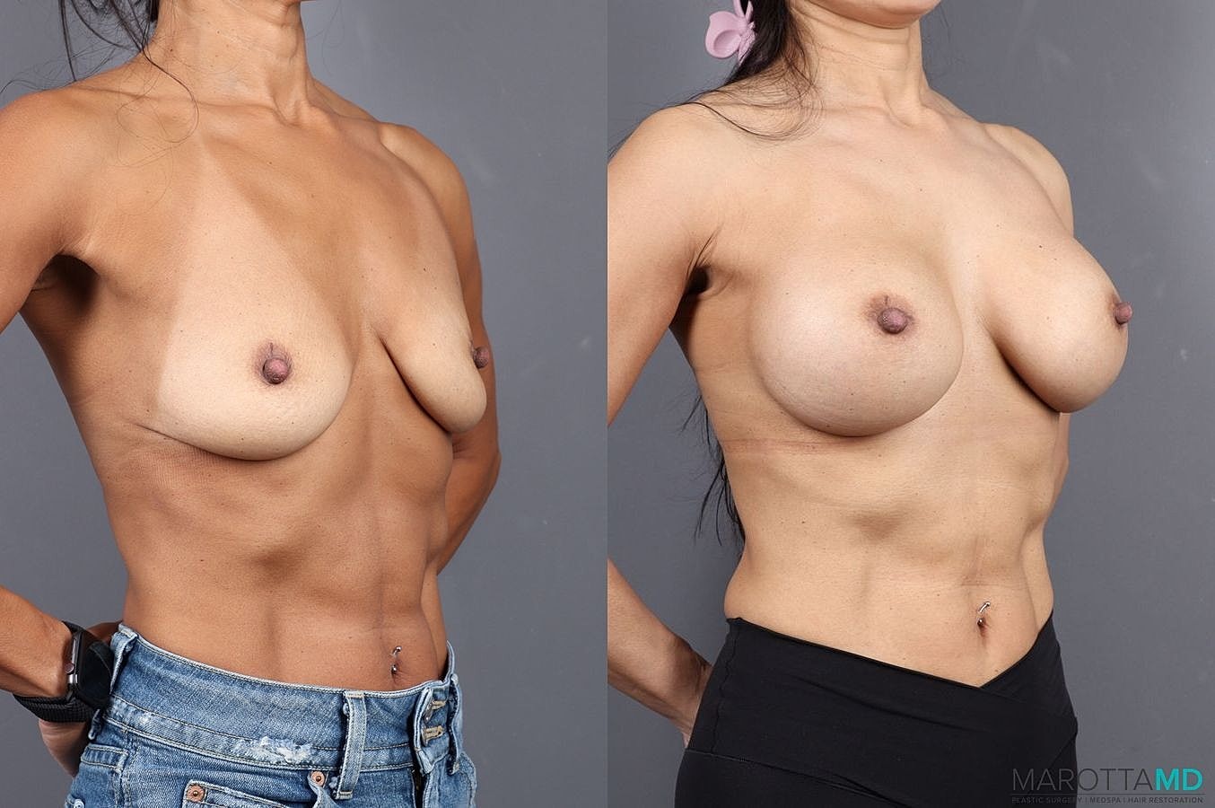 Breast Augmentation Before & After