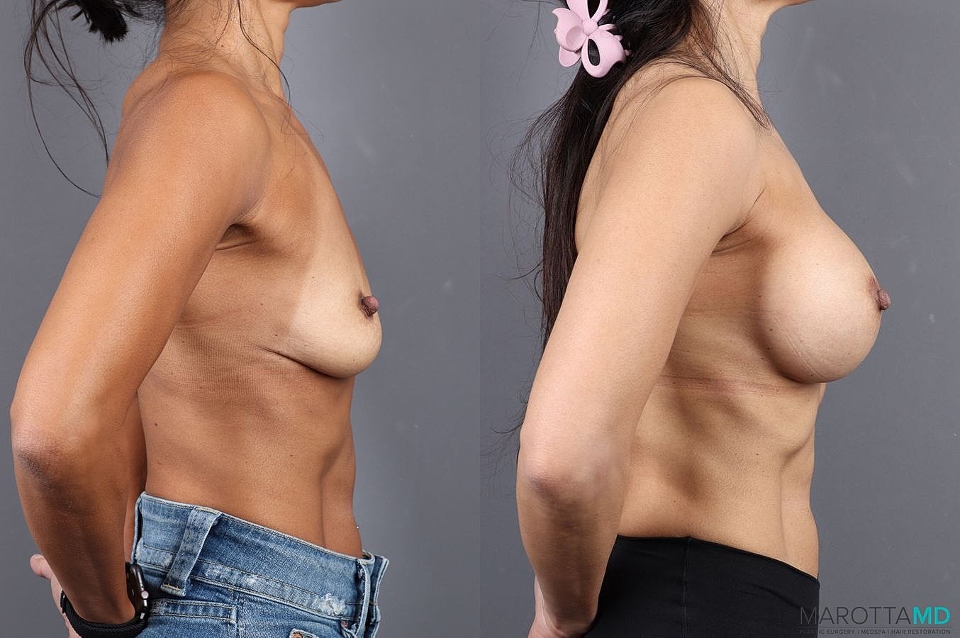Breast Augmentation Before & After