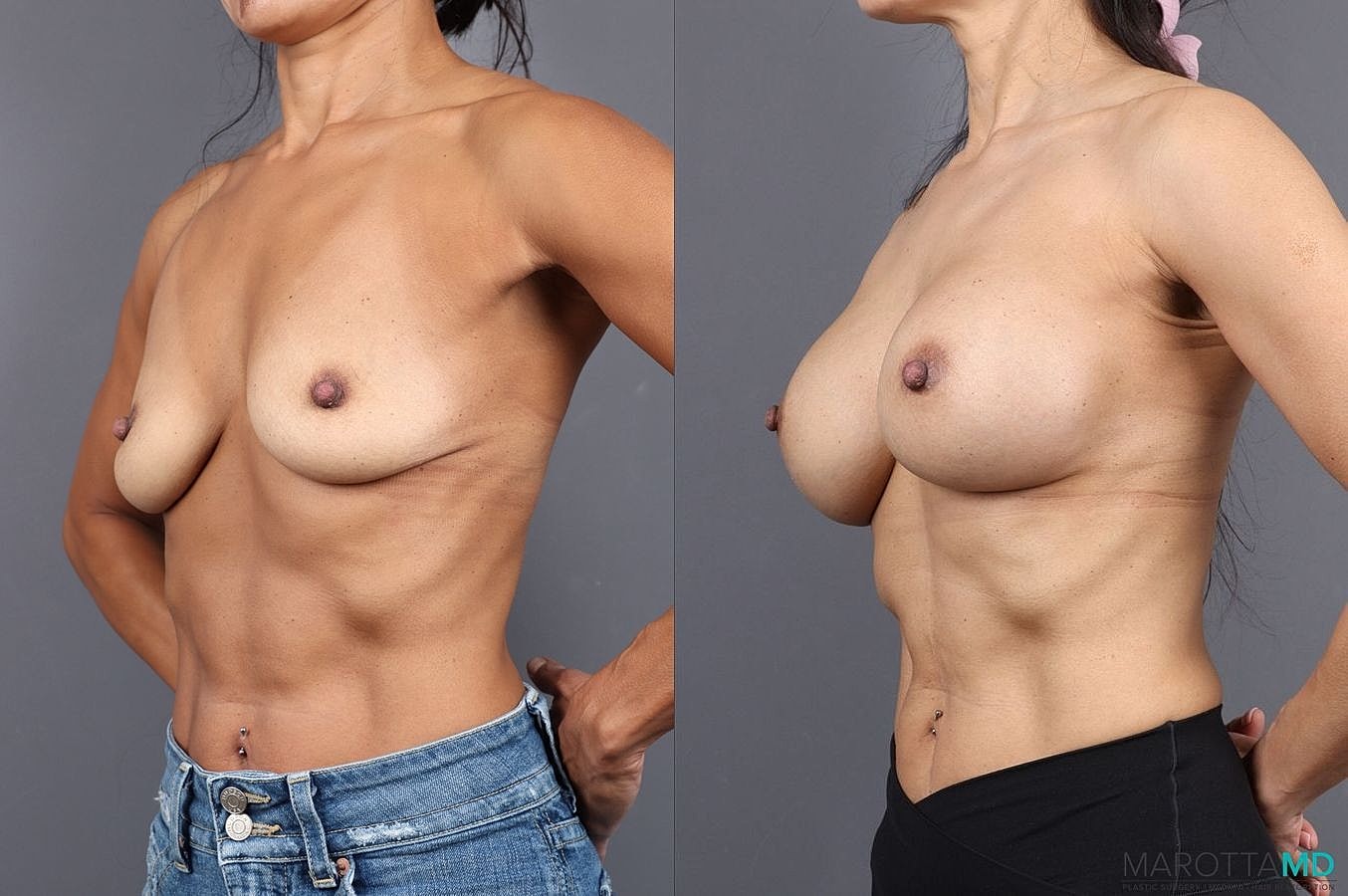 Breast Augmentation Before & After