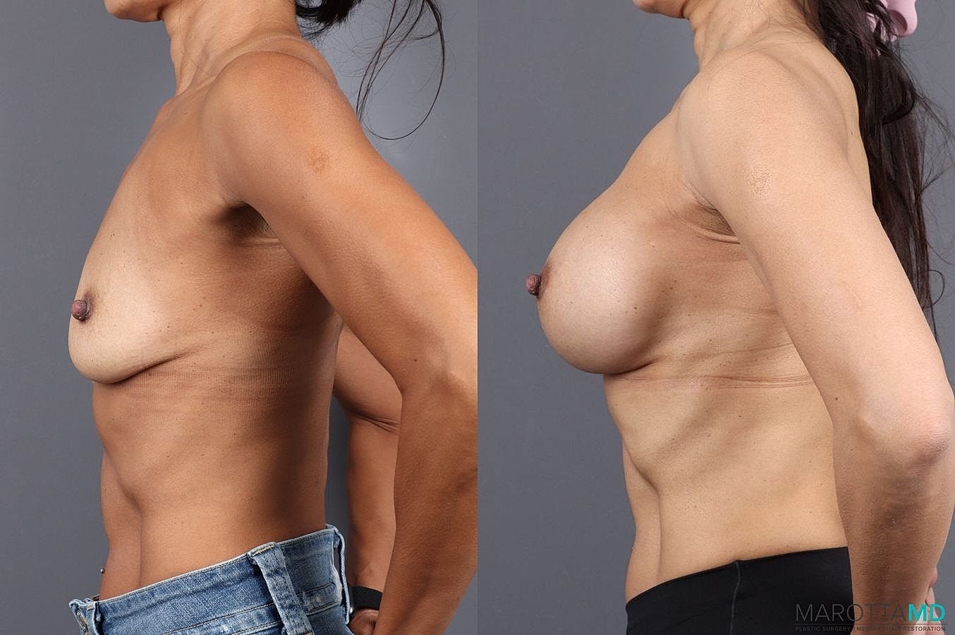 Breast Augmentation Before & After
