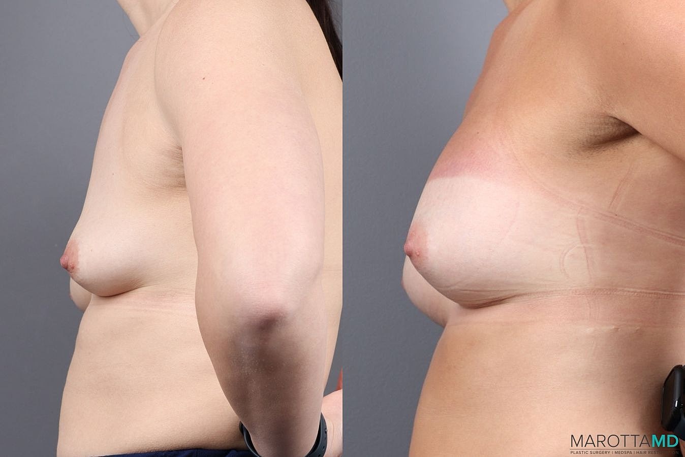 Breast Augmentation Before & After