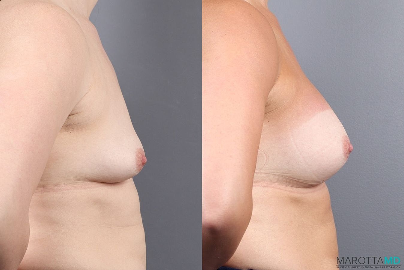 Breast Augmentation Before & After