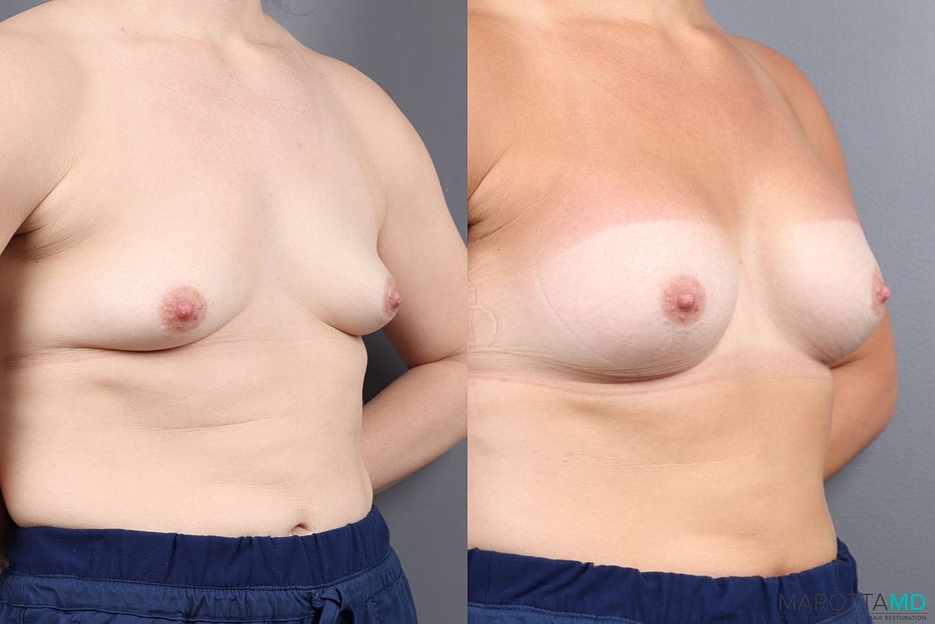 Breast Augmentation Before & After