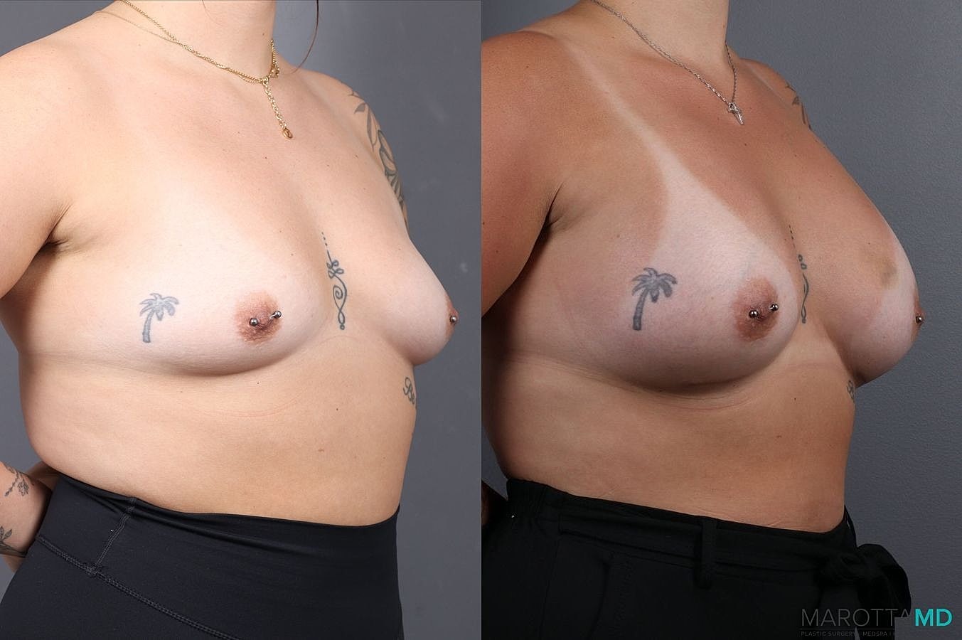 Breast Augmentation Before & After
