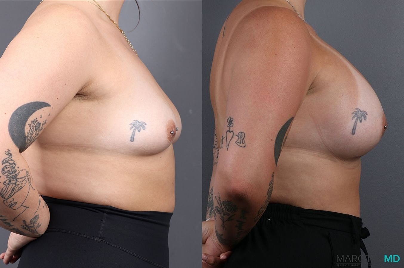 Breast Augmentation Before & After