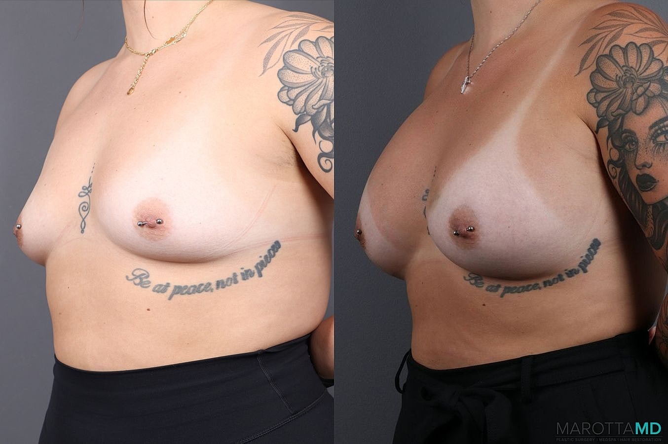 Breast Augmentation Before & After