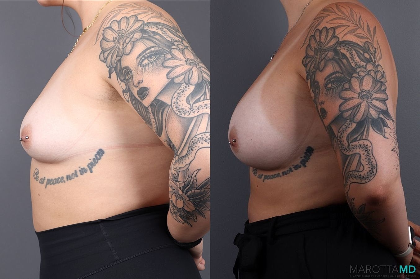 Breast Augmentation Before & After