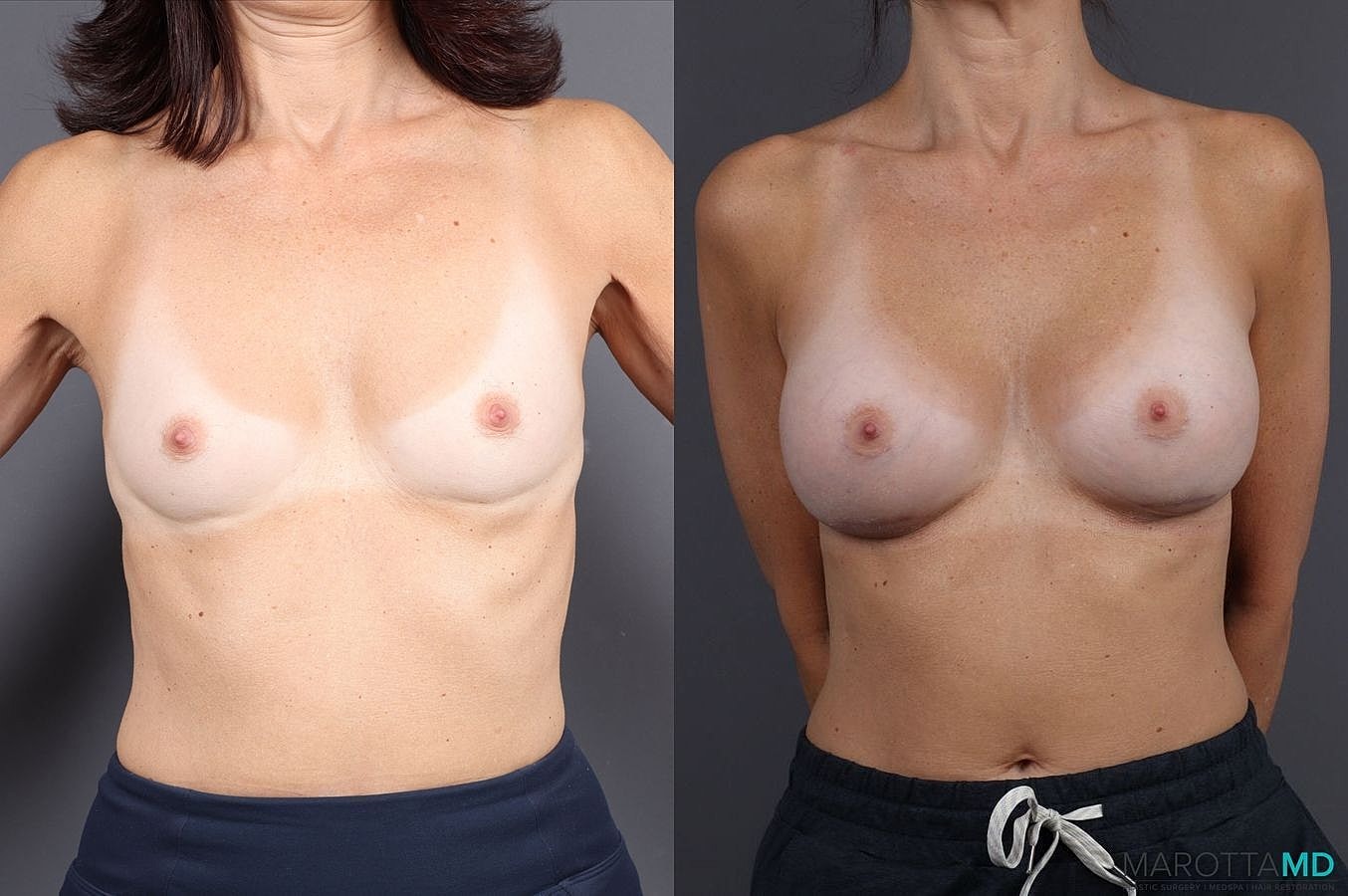 Breast Augmentation Before & After
