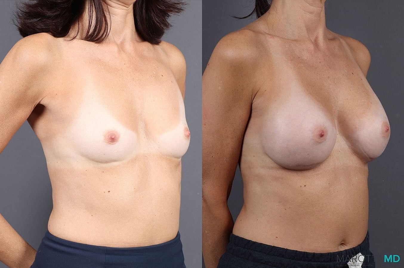 Breast Augmentation Before & After