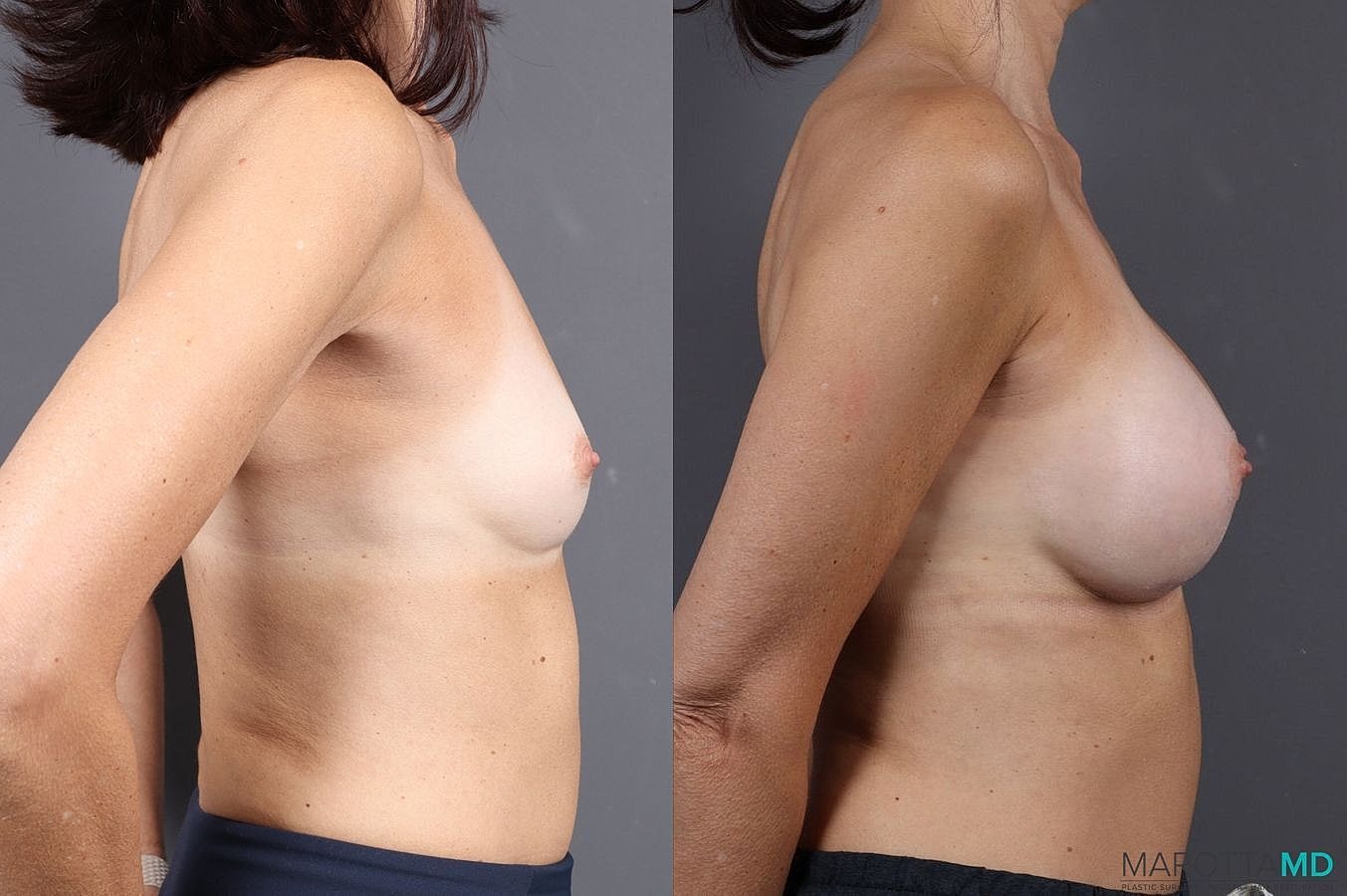Breast Augmentation Before & After