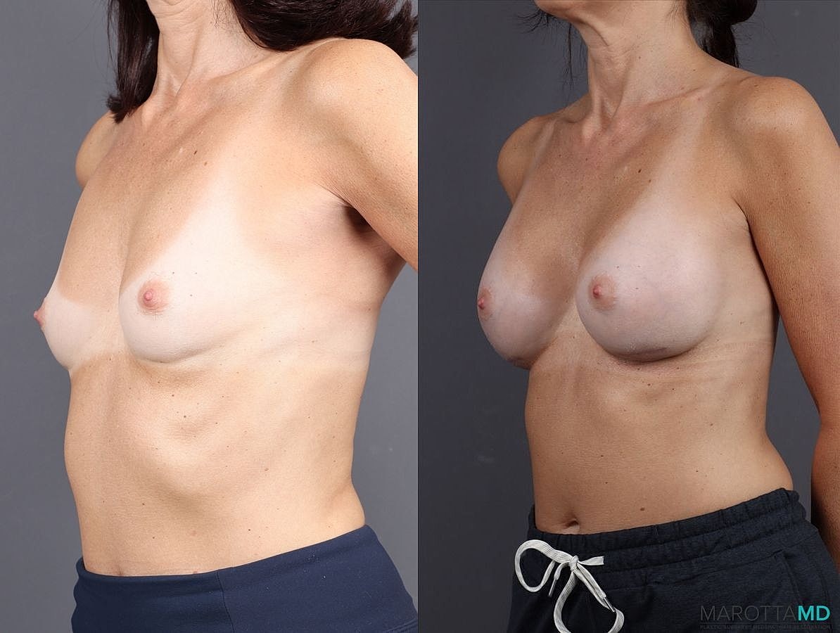Breast Augmentation Before & After