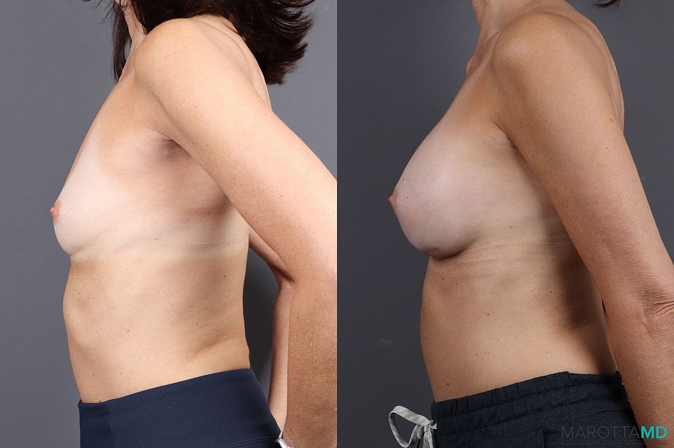Breast Augmentation Before & After