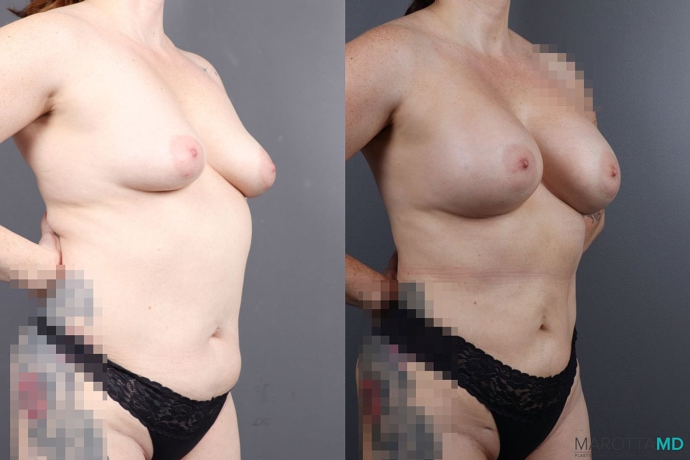 Breast Augmentation Before & After