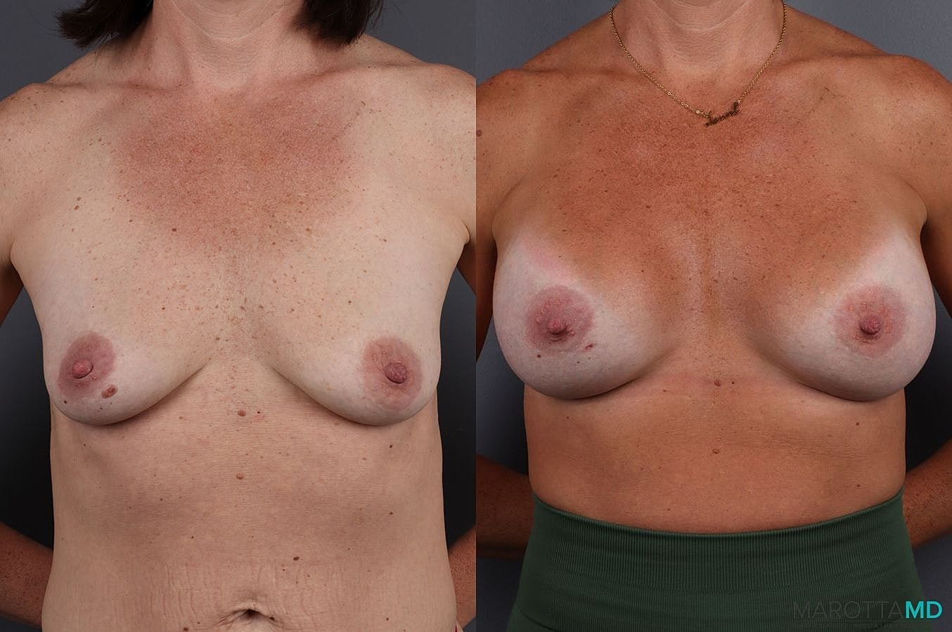 Breast Augmentation Before & After