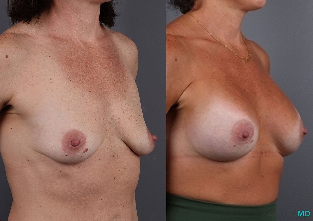 Breast Augmentation Before & After
