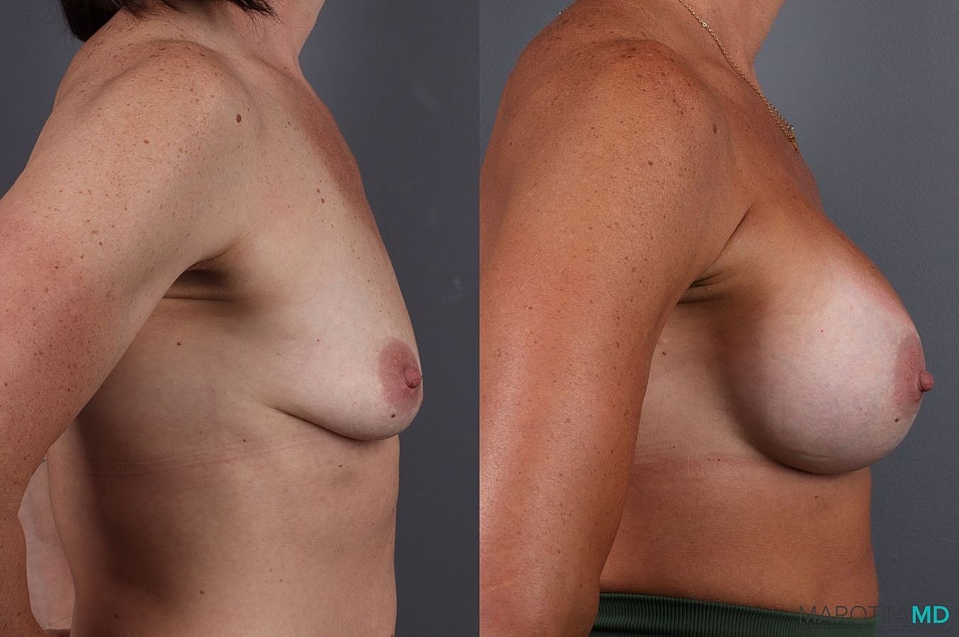 Breast Augmentation Before & After