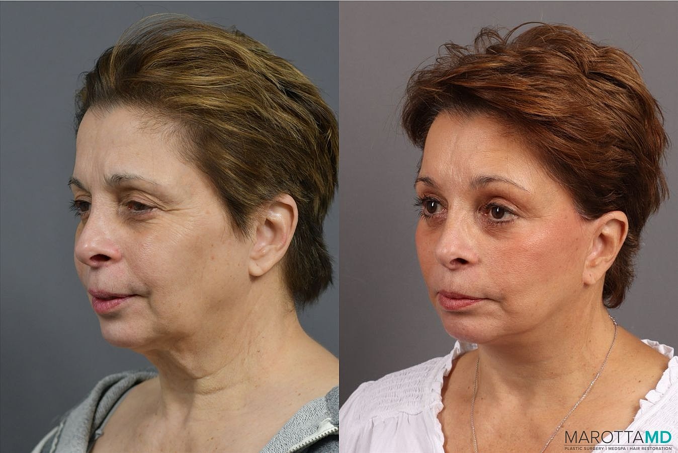 Endoscopic Brow Lift Before & After