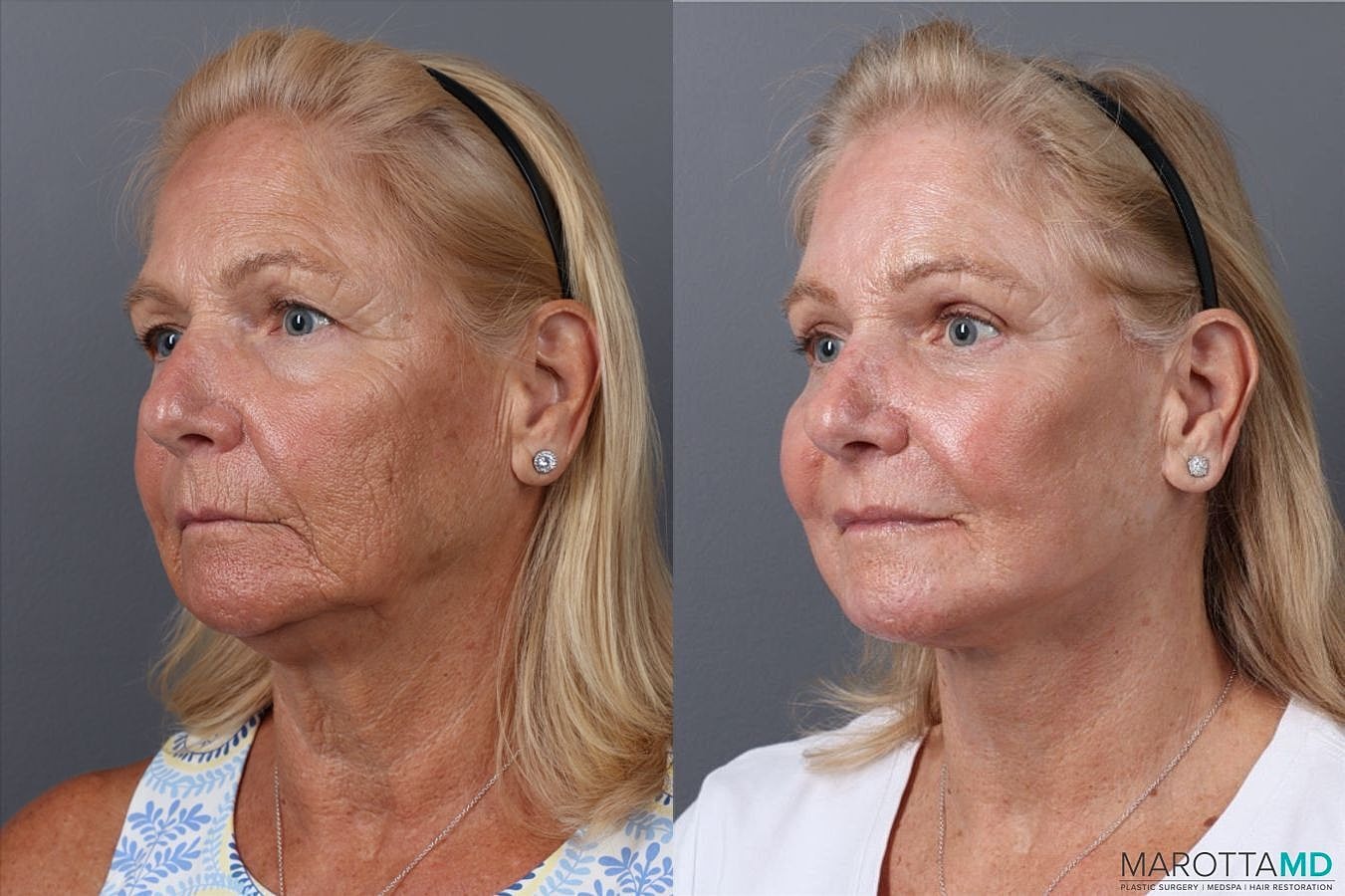 Endoscopic Brow Lift Before & After
