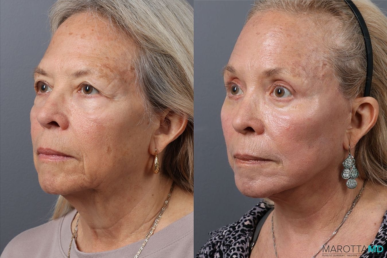 Endoscopic Brow Lift Before & After