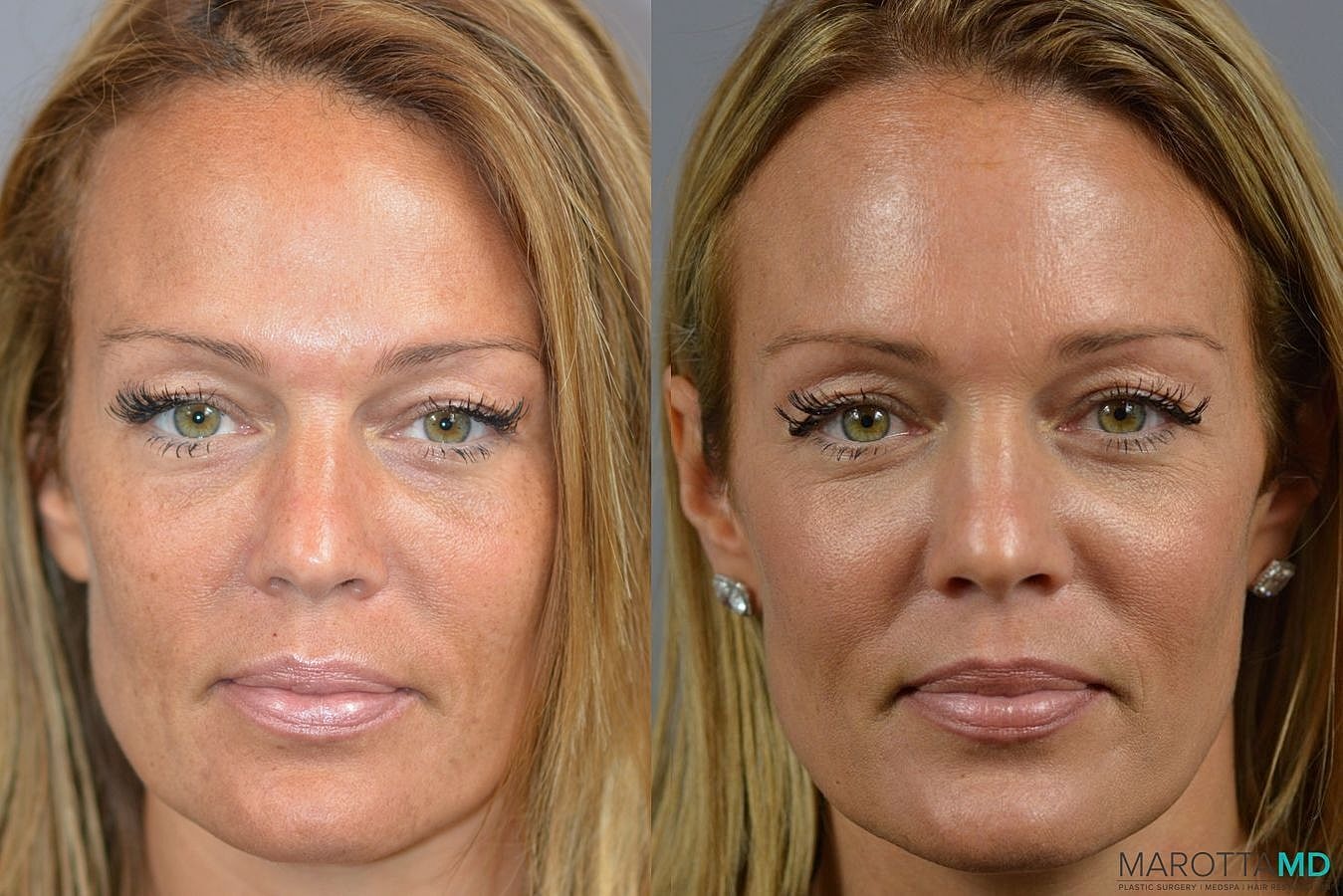 Ultherapy Before & After