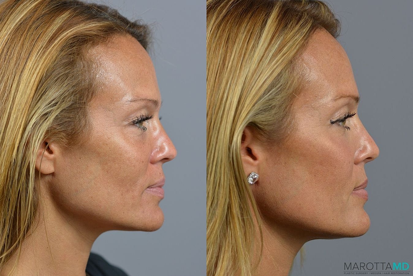 Ultherapy Before & After