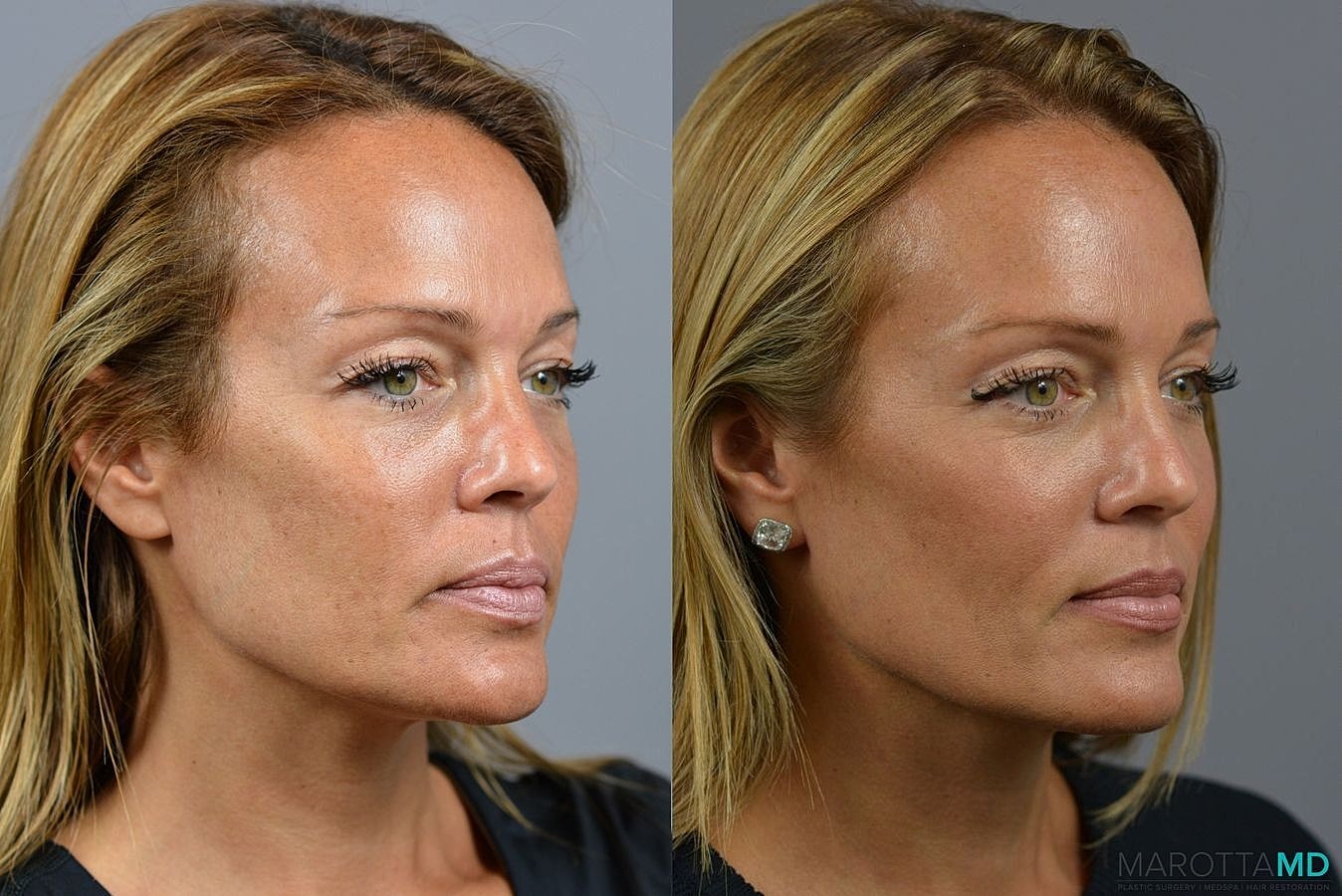 Ultherapy Before & After