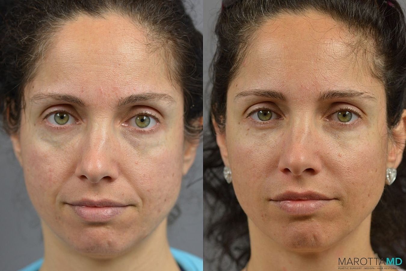 Ultherapy Before & After