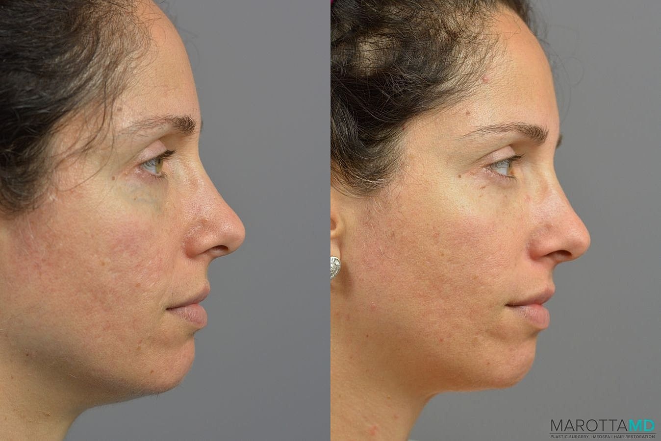 Ultherapy Before & After