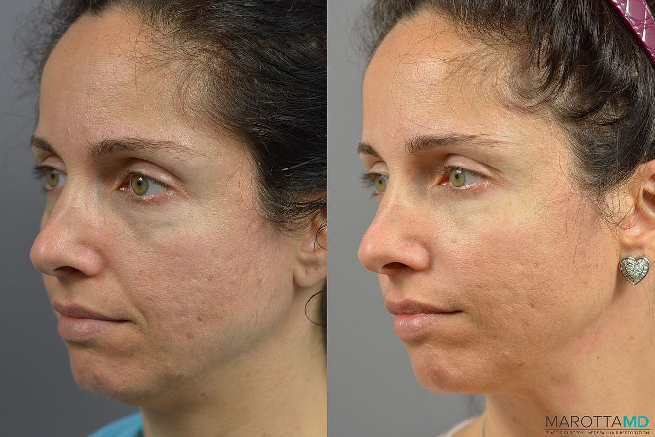 Ultherapy Before & After
