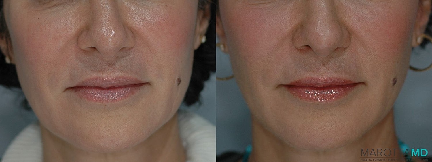 Ultherapy Before & After