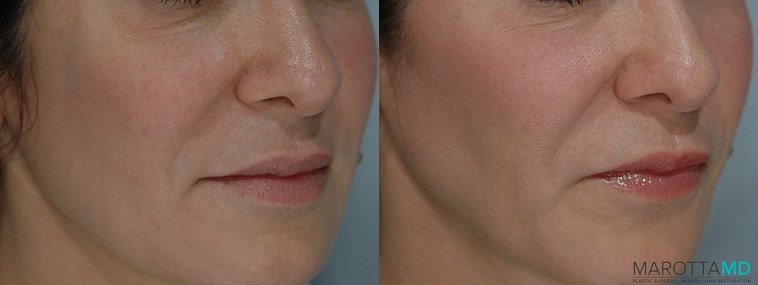 Ultherapy Before & After