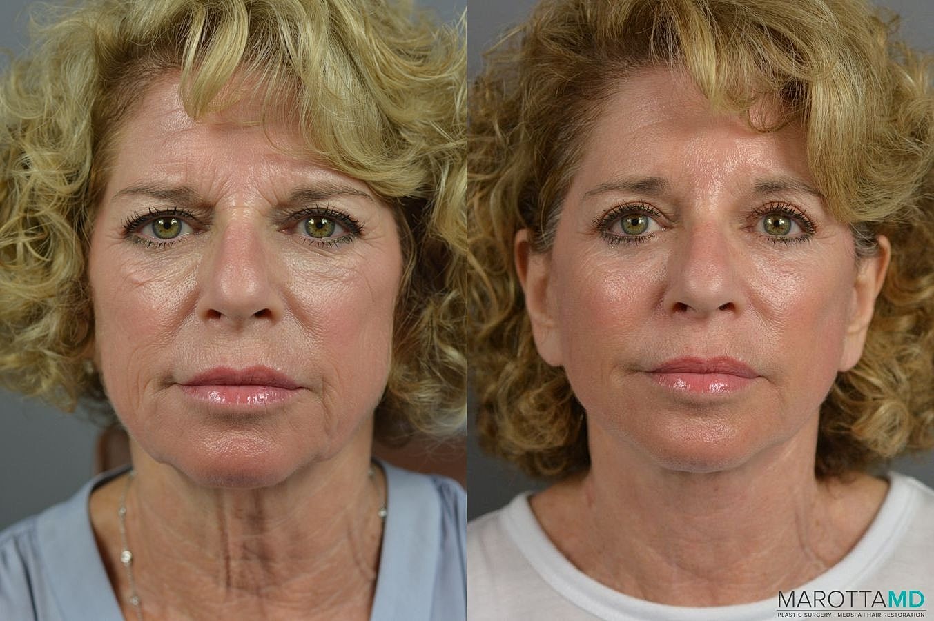 Brow Lift Before & After