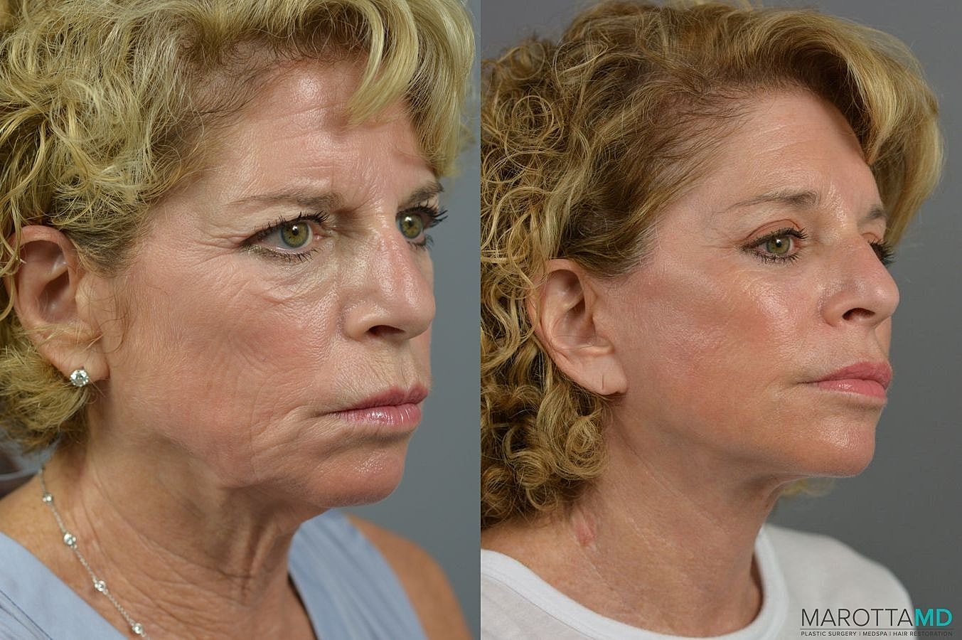 Brow Lift Before & After