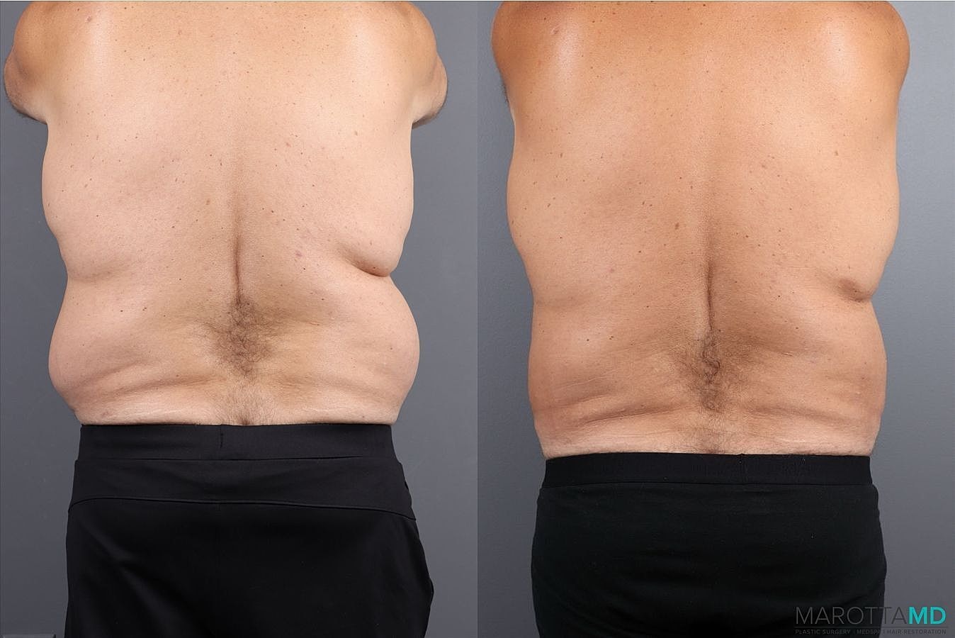 Liposuction Before & After