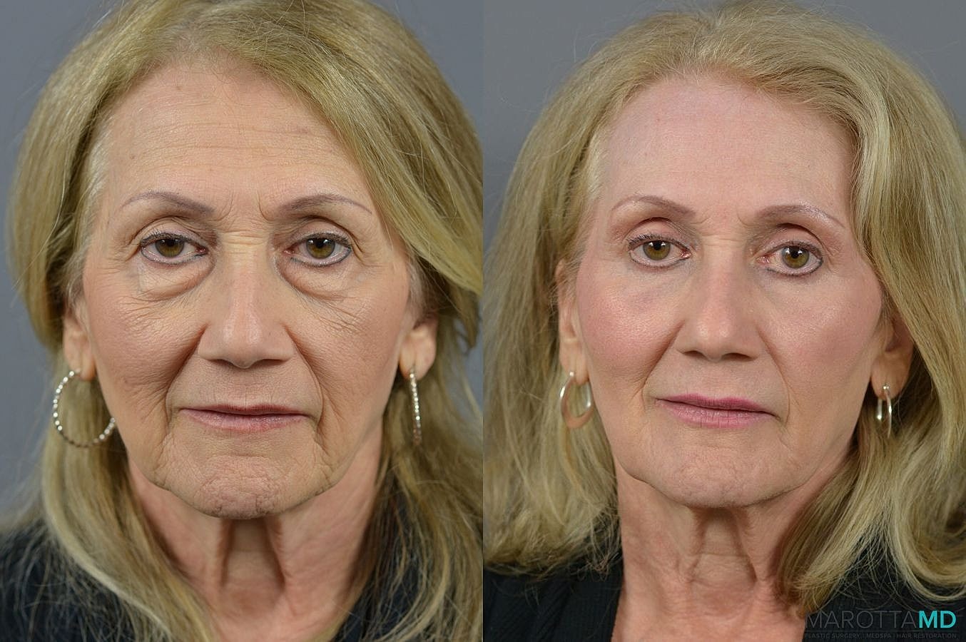 Laser Skin Resurfacing Before & After