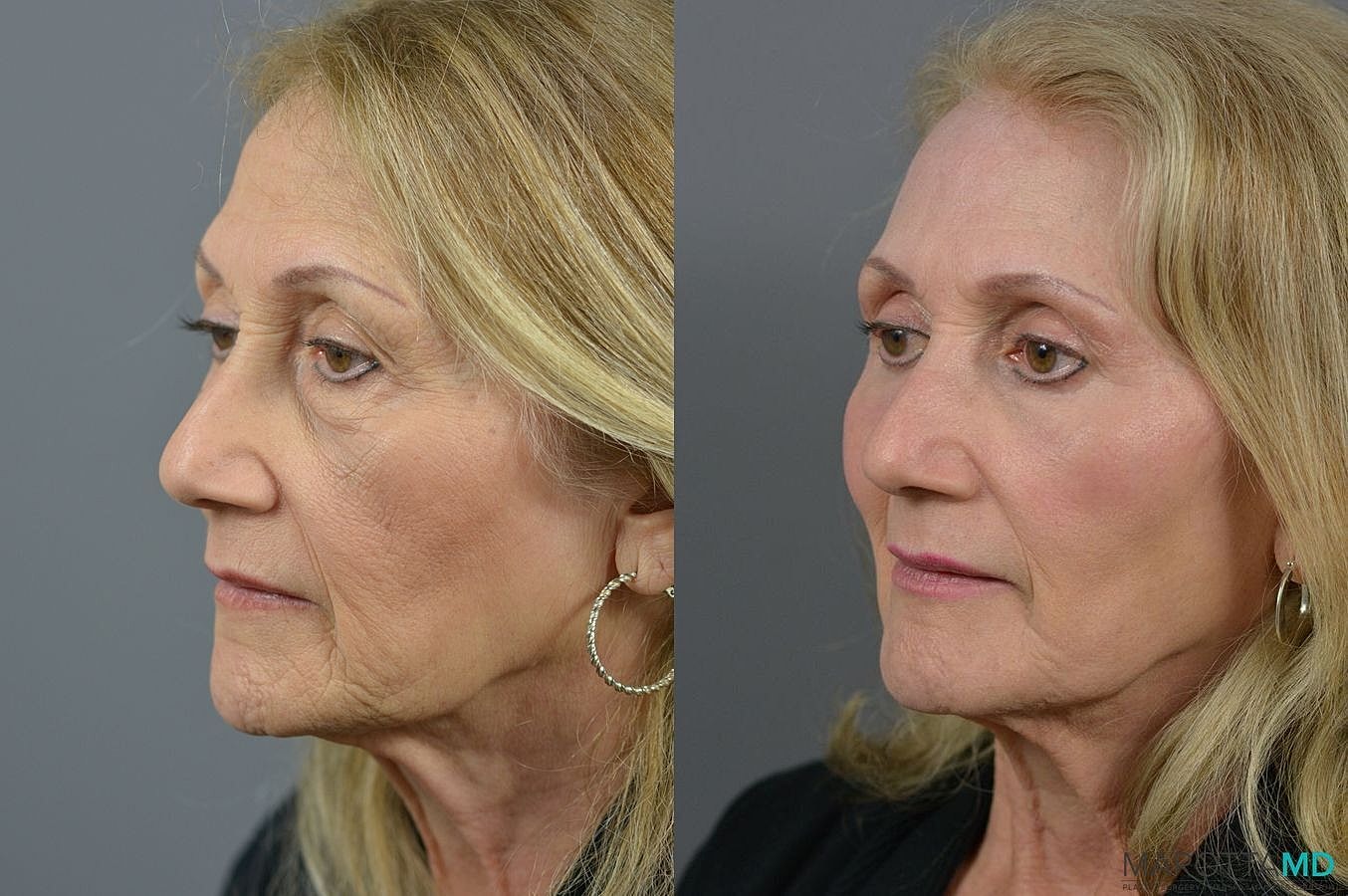 Laser Skin Resurfacing Before & After