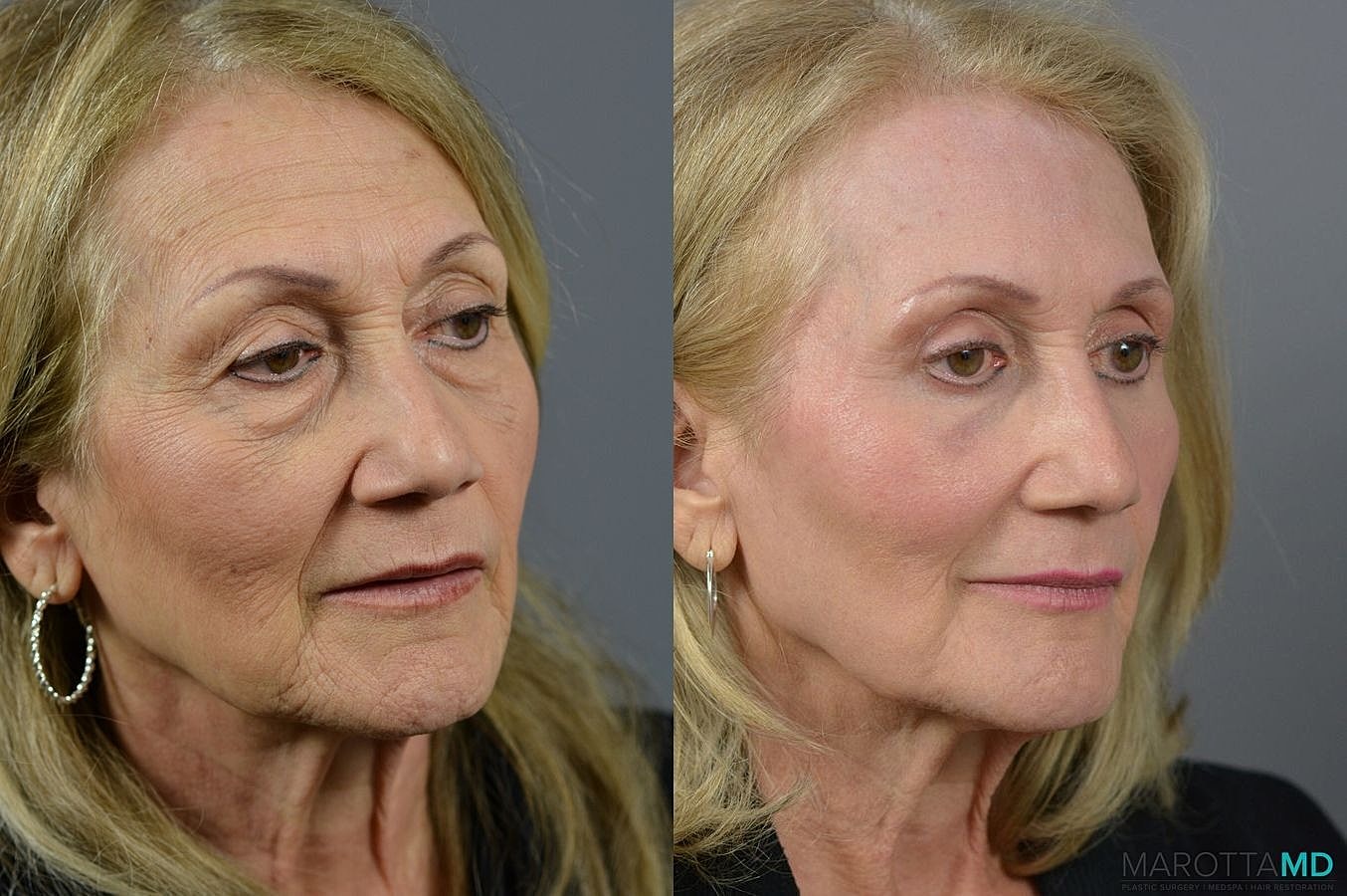 Laser Skin Resurfacing Before & After