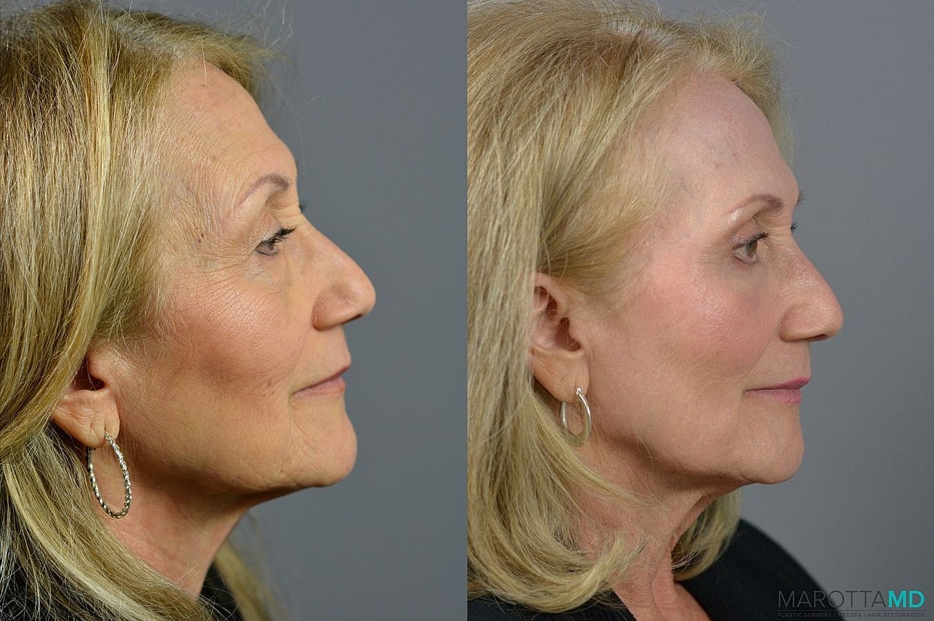 Laser Skin Resurfacing Before & After