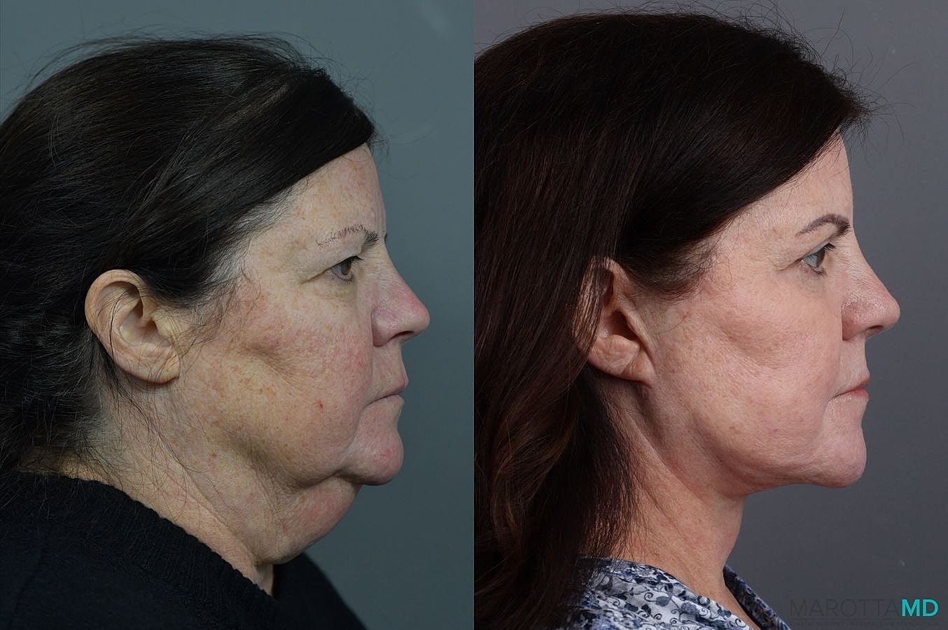 Laser Skin Resurfacing Before & After
