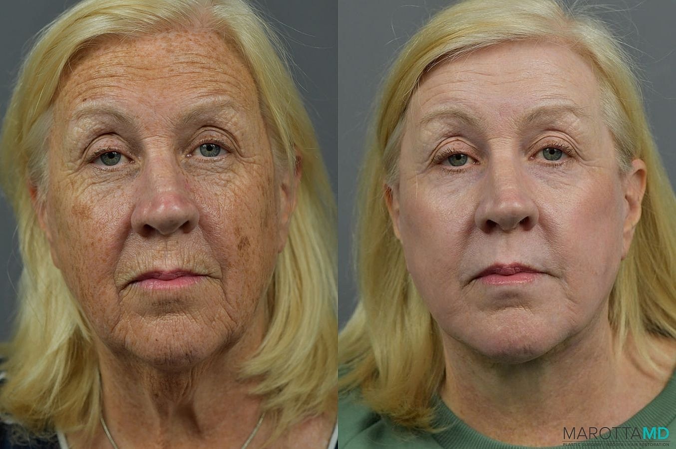 Laser Skin Resurfacing Before & After