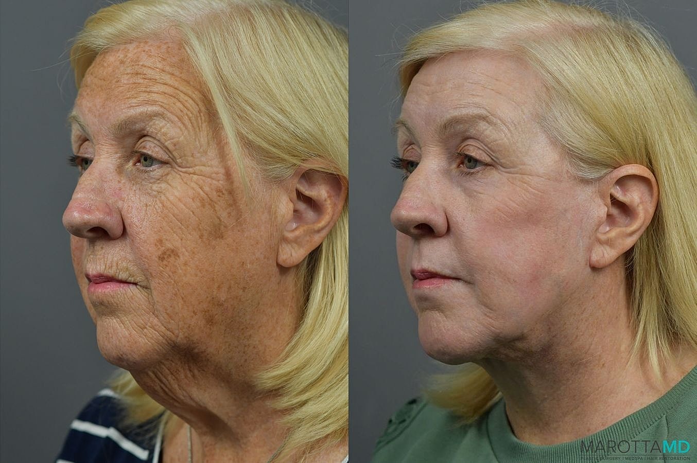 Laser Skin Resurfacing Before & After