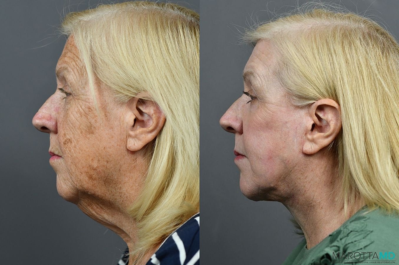 Laser Skin Resurfacing Before & After