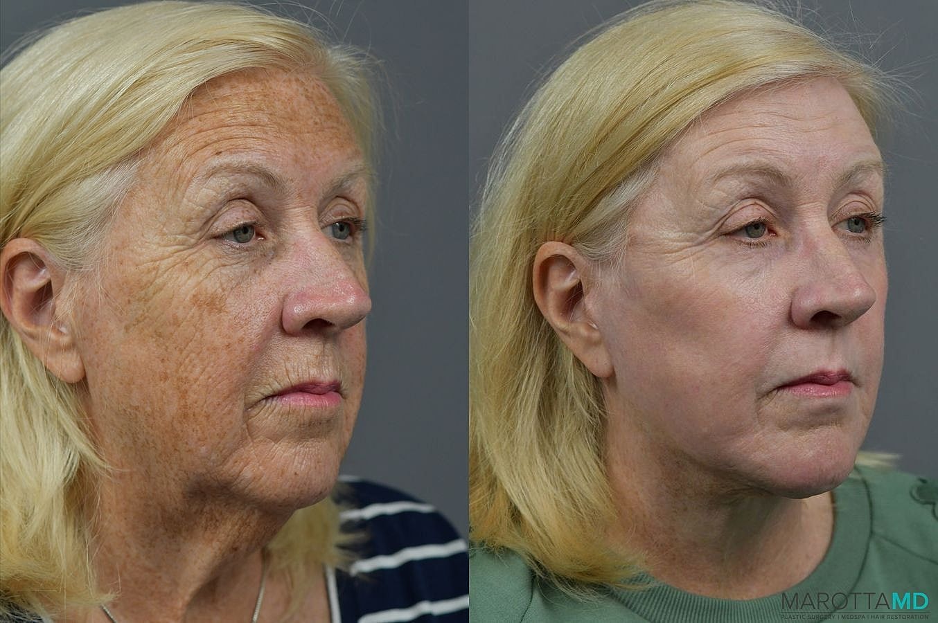 Laser Skin Resurfacing Before & After