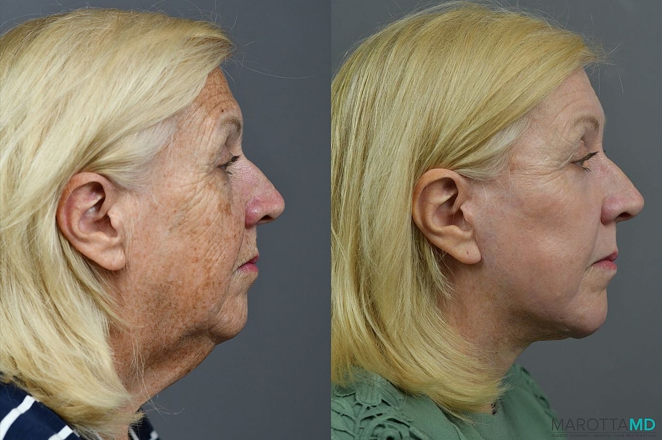 Laser Skin Resurfacing Before & After