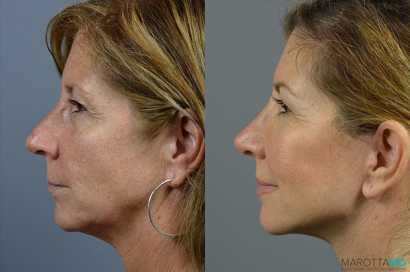Laser Skin Resurfacing Before & After