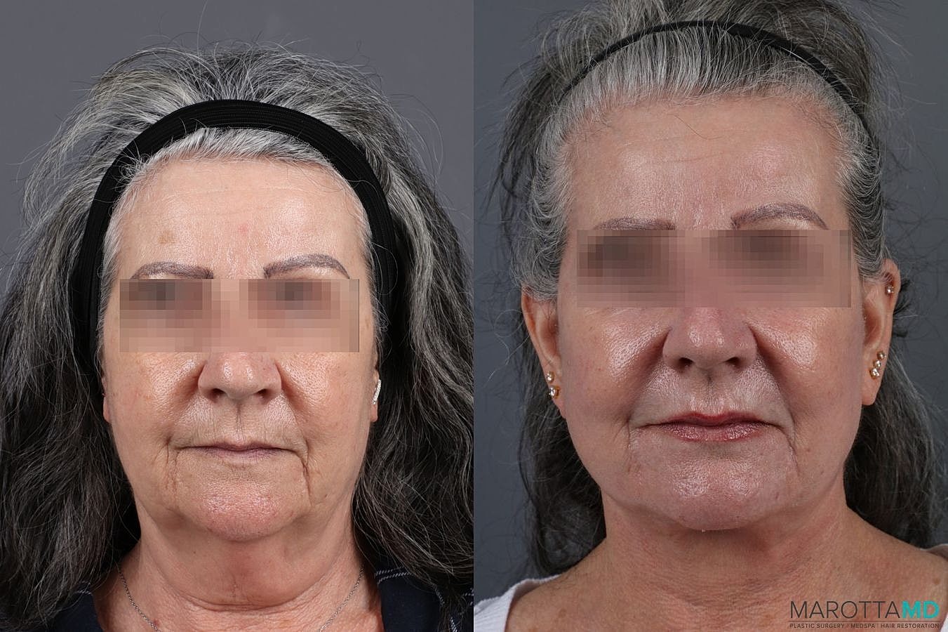 Laser Skin Resurfacing Before & After