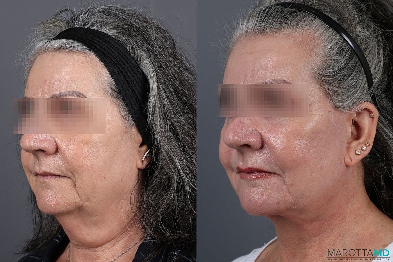 Laser Skin Resurfacing Before & After
