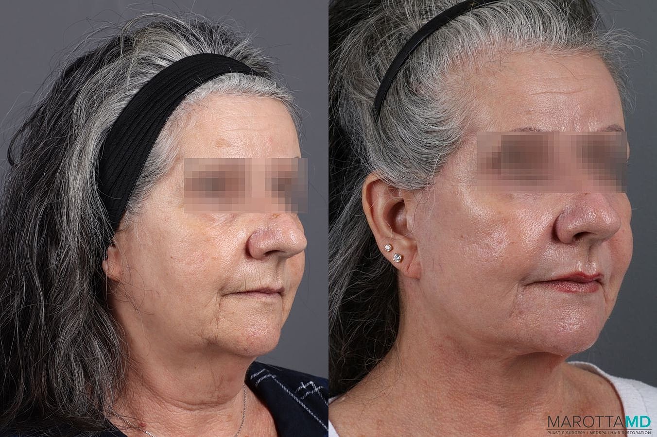 Laser Skin Resurfacing Before & After