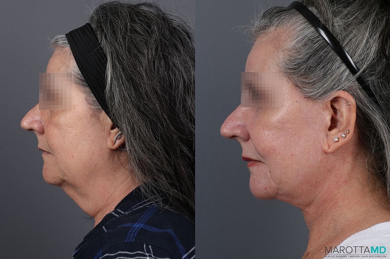 Laser Skin Resurfacing Before & After