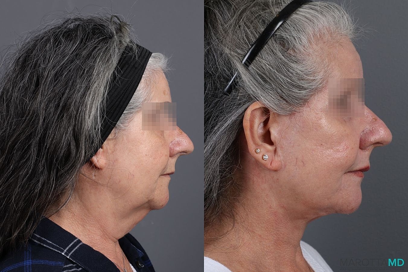 Laser Skin Resurfacing Before & After